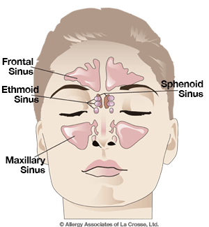 Sinusitis Sinus Infection