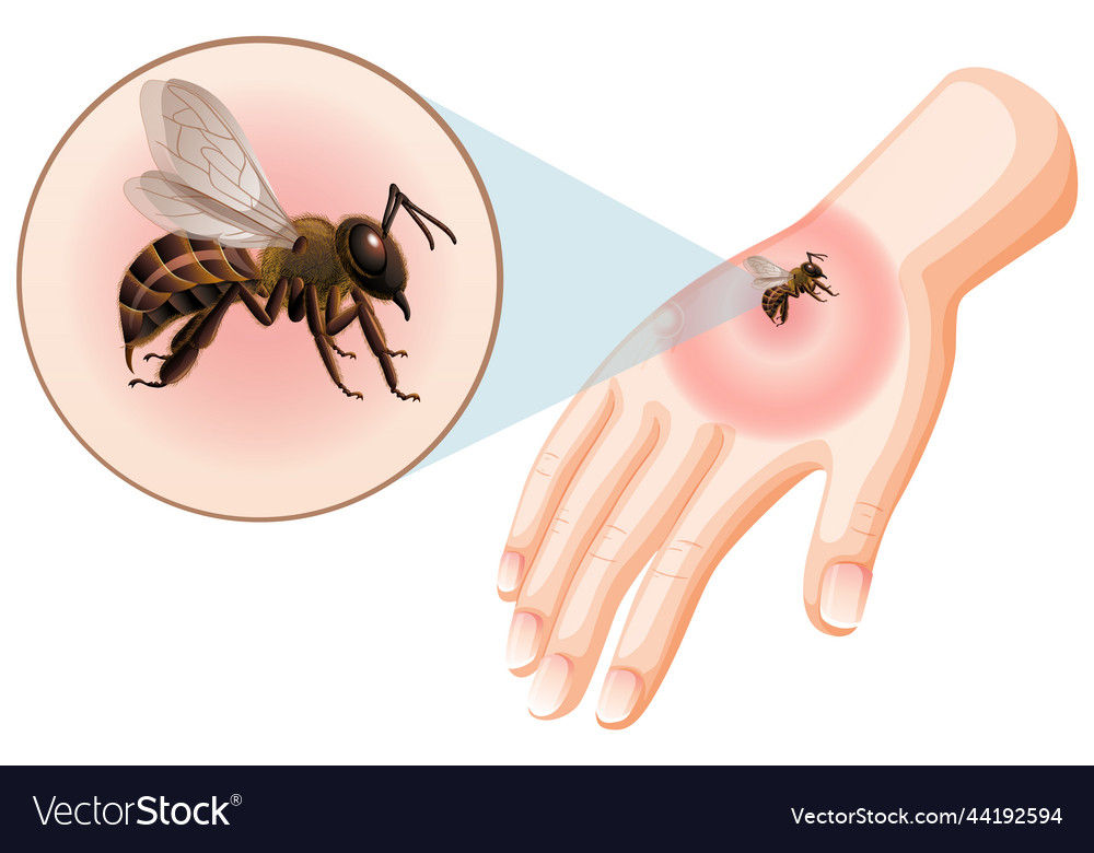 Bee Stings and Insect Bites