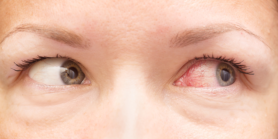 Conjunctivitis Pink Eye & Eye Infections